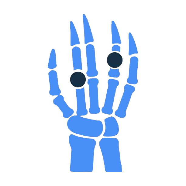Rheumatoid Arthritis
